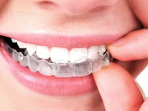 Invisalign Teen In Mount Kisco Ny