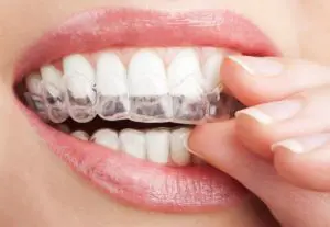 How Expensive Is Invisalign