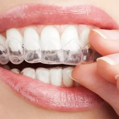 How Expensive Is Invisalign