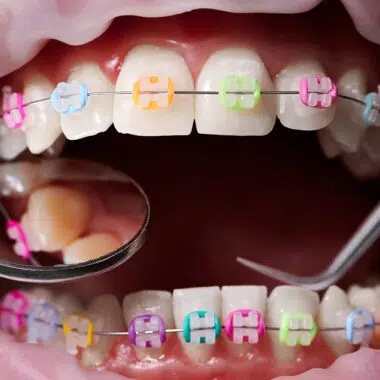 Tooth Decay With Braces
