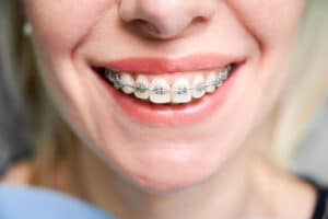 Braces Westchester NY