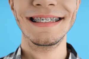 Invisalign Vs. Braces