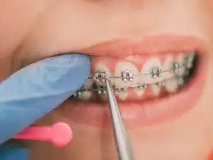 Adult-Braces Wire Loose