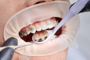 Clear Braces Vs Invisalign