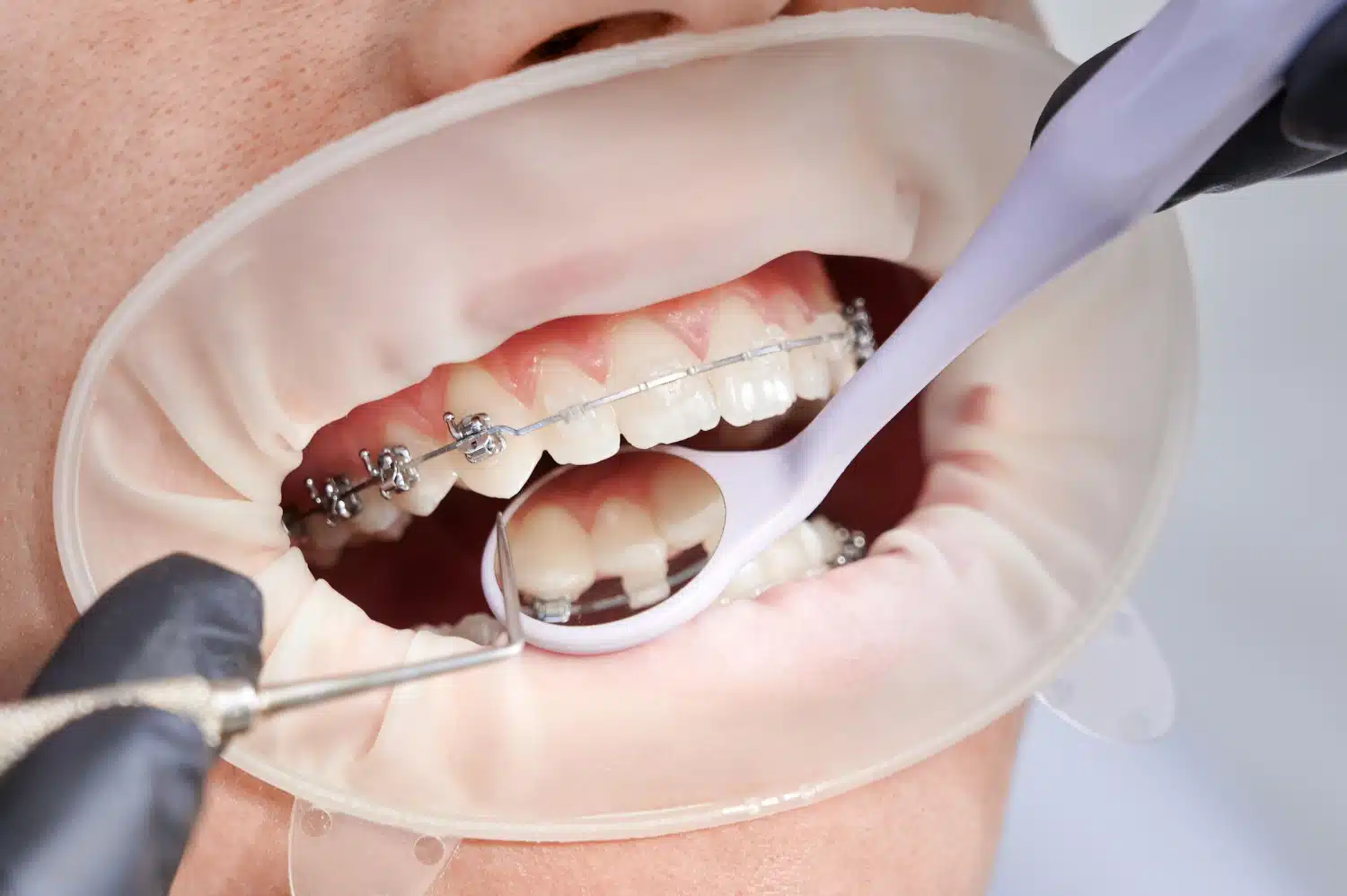 clear braces vs invisalign