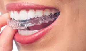 Clear Braces Vs Invisalign: A Side-By-Side Comparison Clear Braces Vs Invisalign