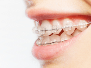 Clear Braces Mount Kisco NY