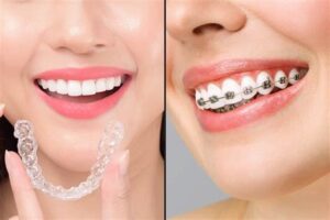 Invisalign Vs Braces