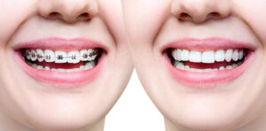 Aligners Vs Braces