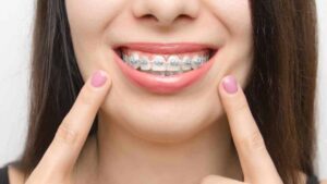 Braces Treatment For Adults