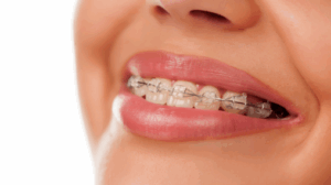 3D-Printed Braces