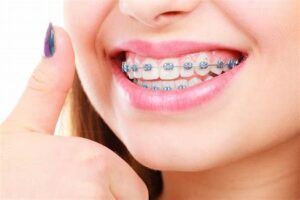 3D-Printed Braces