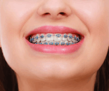3D-Printed Braces: How Customisation Is Changing Everything 3D-Printed Braces