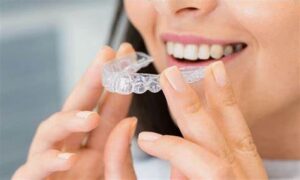 Invisalign Help