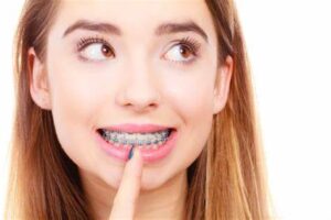 Cost Of Adult Braces