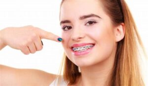 Cost Of Adult Braces