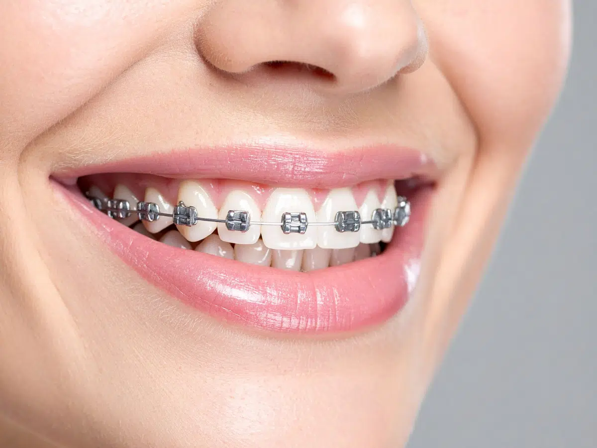 Braces 101