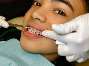 Braces Timeline: What To Expect From Start To Finish What To Expect During Your Braces Treatment?