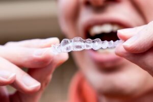 Invisalign Clear Aligners For Teen Orthodontic Treatment