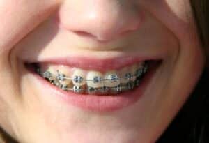 Teen Smiling With Braces During Orthodontic Treatment