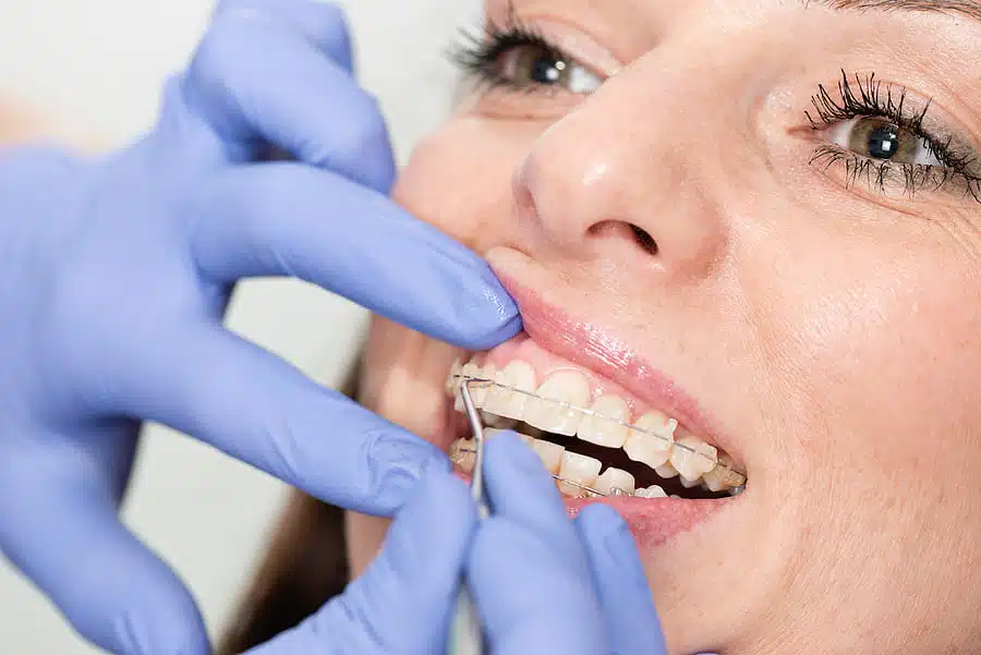 clear braces near Bedford NY at Smile Style NY
