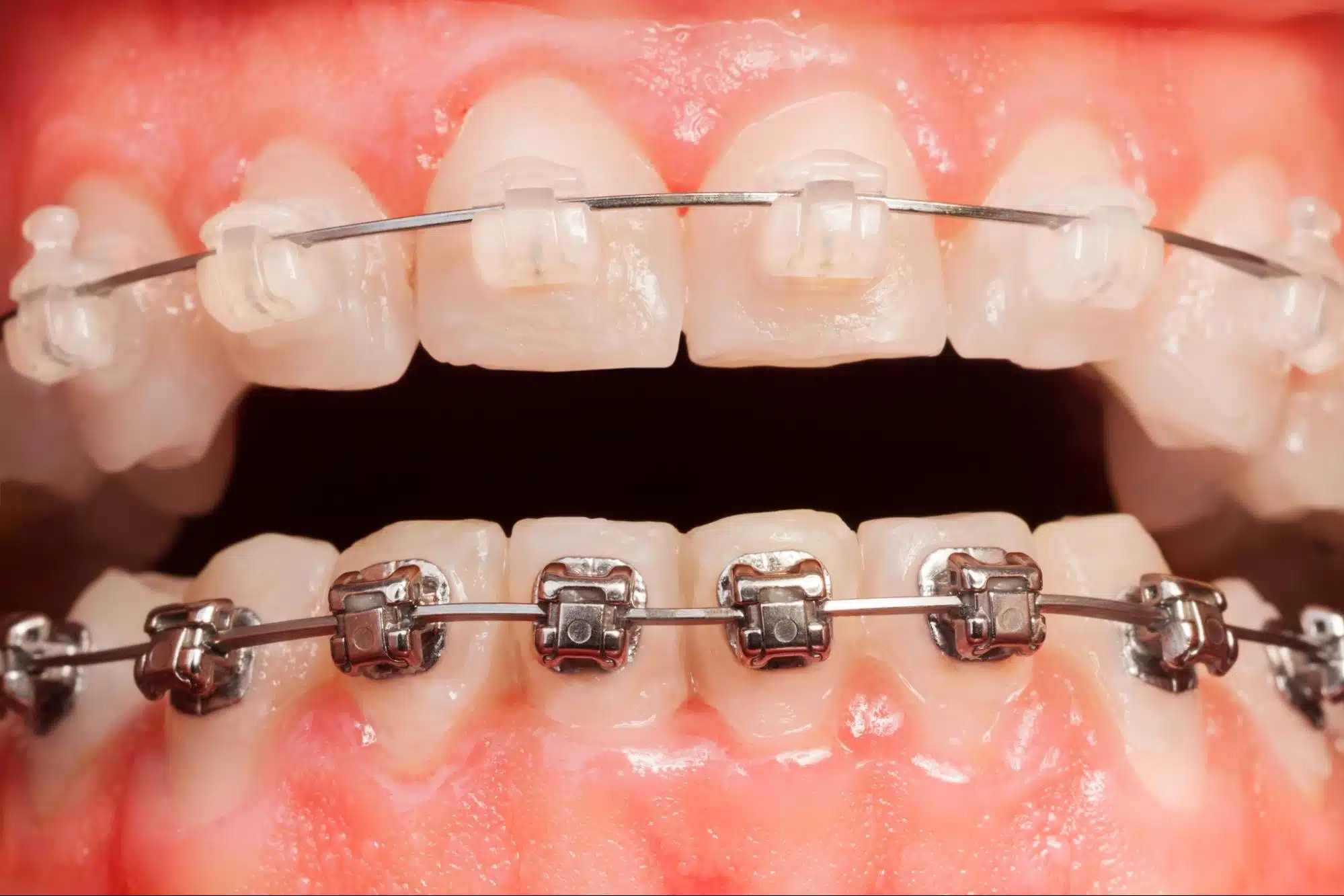 braces consultation near Chappaqua NY
