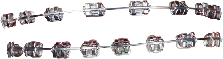 Traditional Braces
